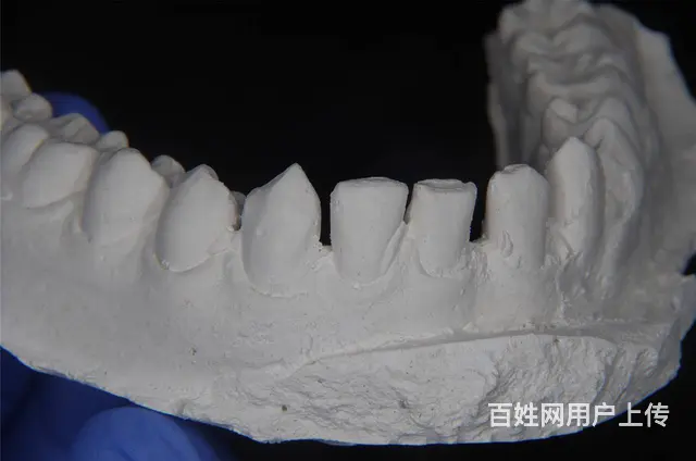 哈尔滨镶牙那个诊所比较好 - 图片 2