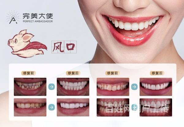 完美i大使美牙效果真相怎么样,实际美牙案例让你放心