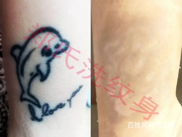洗纹身就到辽阳郑氏洗纹身签合同包洗干净各种彩色纹身 - 图片 11