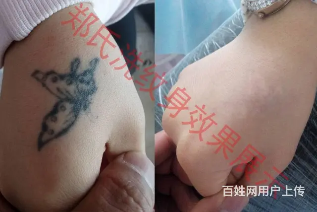 沈阳洗纹身郑氏洗纹身承接别处洗不掉的所有纹身包洗净 - 图片 11