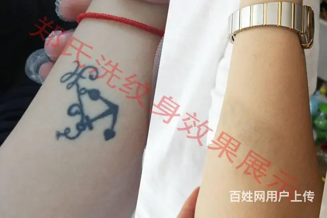 沈阳一次性洗纹身郑氏洗纹身包洗干净所有纹身签订合同 - 图片 9