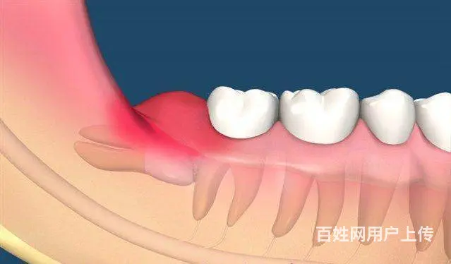 智齿一定要拔掉吗，看看哈尔滨牙医怎么说 - 图片 1