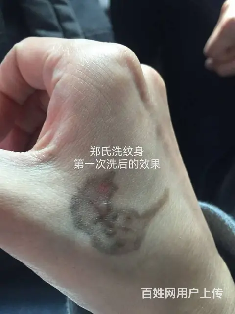 美女小雅洗净虎口纹身感谢郑氏洗纹身工作室 - 图片 2