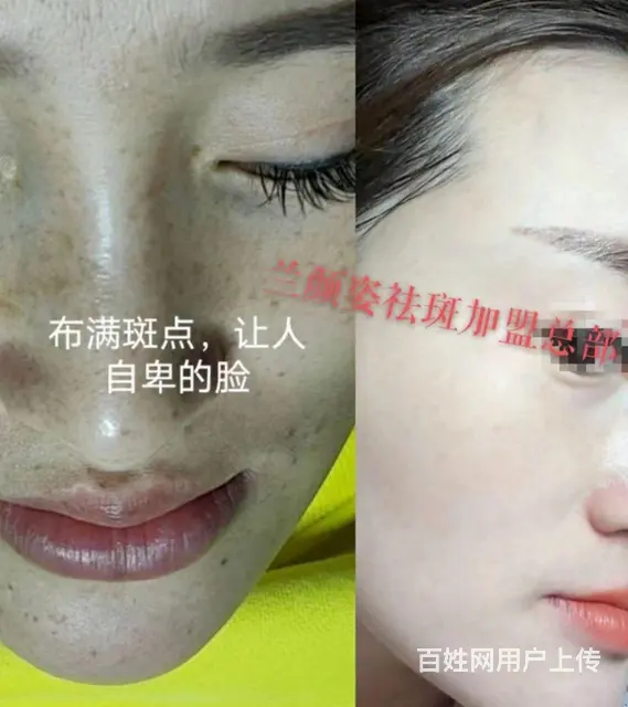 黄褐斑怎么去除 - 图片