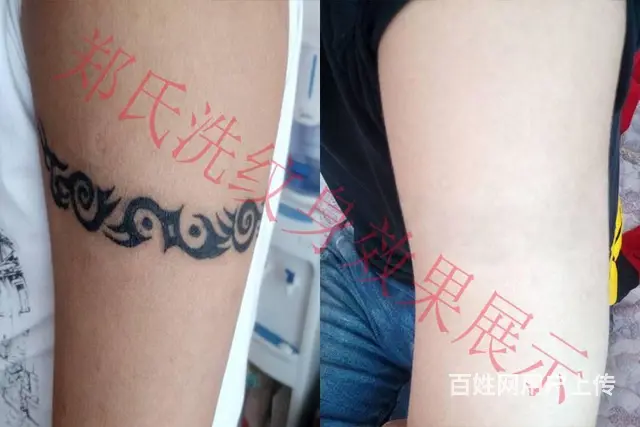 吉林长春四平洗不掉纹身到辽阳郑氏洗纹身签合同包洗掉 - 图片 1