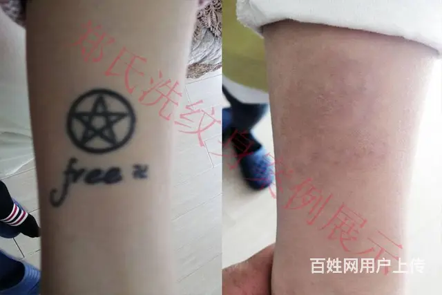 专洗别处洗不掉的所有纹身郑氏洗纹身签合同包洗干净 - 图片 11