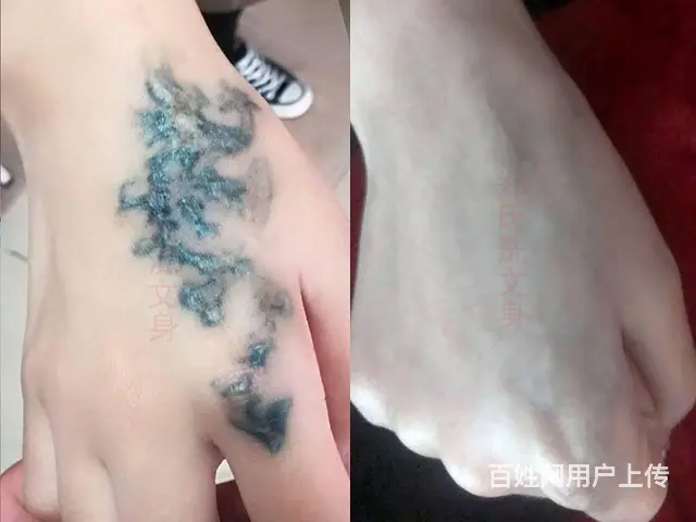 鞍山沈阳大连洗纹身到辽阳郑氏洗纹身包洗掉 - 图片 8