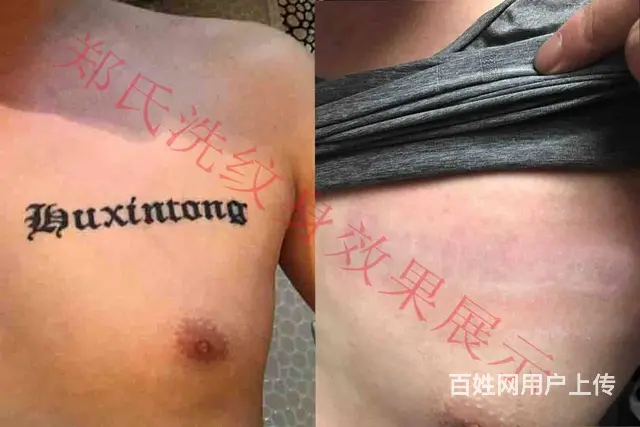 北京天津洗不掉的纹身到辽阳郑氏洗纹身签合同包洗干净 - 图片 3