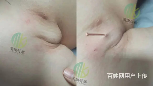 重庆针灸美雕的原理是什么 - 图片 3
