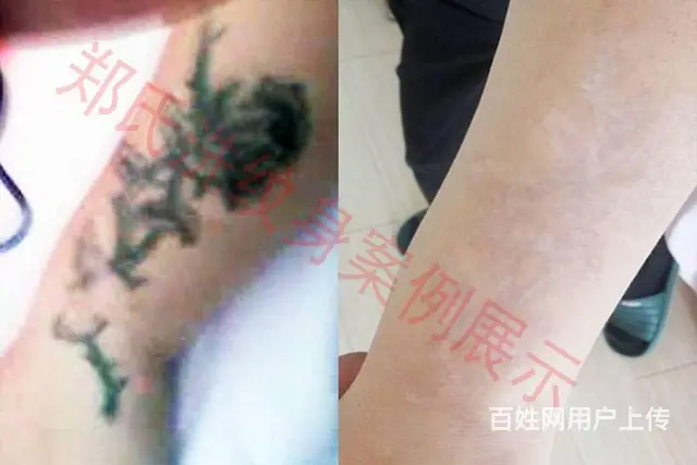 沈阳洗纹身专洗别处洗不掉的所有纹身郑氏洗纹身包洗净 - 图片 10