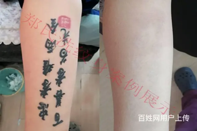 洗纹身哪家好辽阳郑氏洗纹身专业技术签合同包洗效果好 - 图片 1
