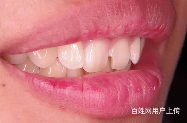 哈尔滨牙齿美白哪里比较好 - 图片 2