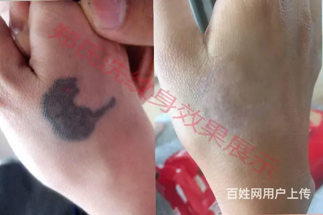 沈阳洗纹身一次性洗净纹身郑氏洗纹身包洗干净所有纹身 - 图片 1