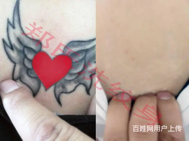 洗纹身洗不掉就到辽阳郑氏洗纹身 - 图片 8