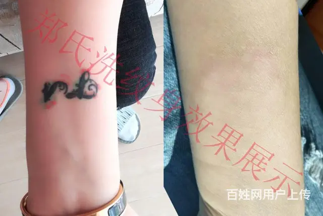 北京天津洗不掉的纹身到辽阳郑氏洗纹身签合同包洗干净 - 图片 1