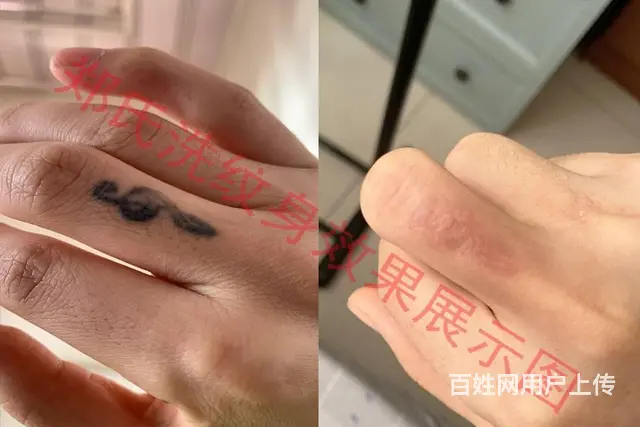 沈阳洗纹身一次洗净纹身郑氏洗纹身签合同包洗干净纹身 - 图片 3