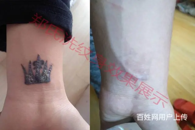 沈阳洗纹身郑氏洗纹身一次洗净纹身签合同包洗所有纹身 - 图片 4