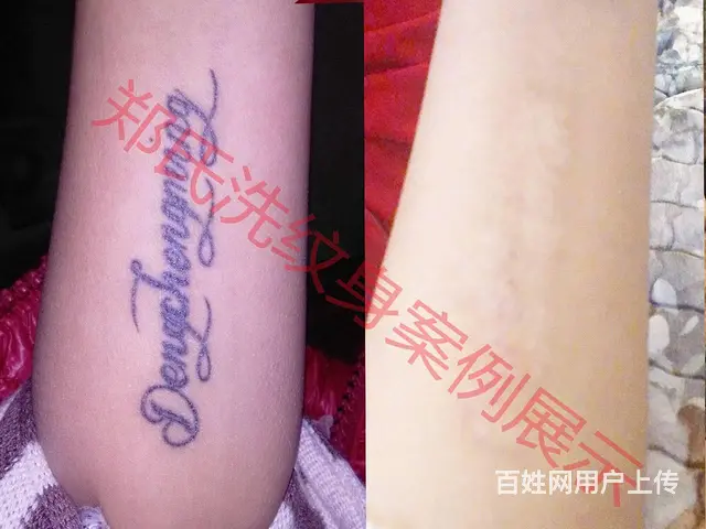 沈阳洗纹身一次洗净纹身郑氏洗纹身签合同包洗所有纹身 - 图片 12
