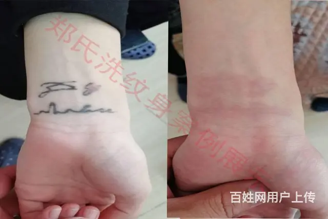 沈阳洗纹身郑氏洗纹身承接别处洗不掉的所有纹身包洗净 - 图片 10