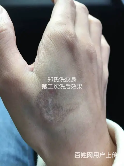 美女小雅洗净虎口纹身感谢郑氏洗纹身工作室 - 图片 3