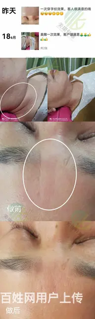 石家庄美康针灸美雕蝴蝶袖效果好 - 图片 2