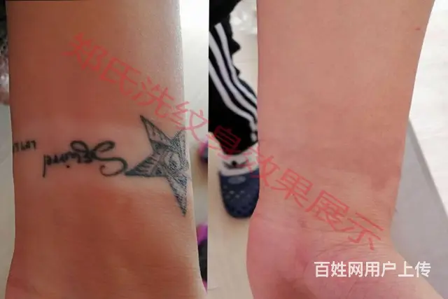 沈阳洗纹身一次性洗纹身签合同包洗所有纹身郑氏洗纹身 - 图片 1