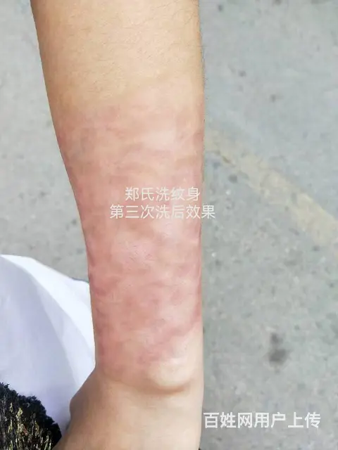 洗纹身失败后纹一个更大彩色纹身遮盖还能洗掉吗 - 图片 4