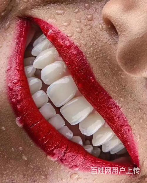 昆明美牙贴面 牙齿贴面培训学校