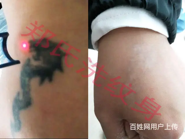 洗纹身就到辽阳郑氏洗纹身签合同包洗干净各种彩色纹身 - 图片 4