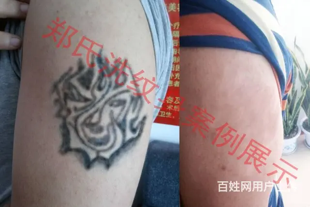 沈阳洗纹身一次性洗净纹身郑氏洗纹身包洗干净所有纹身 - 图片 6