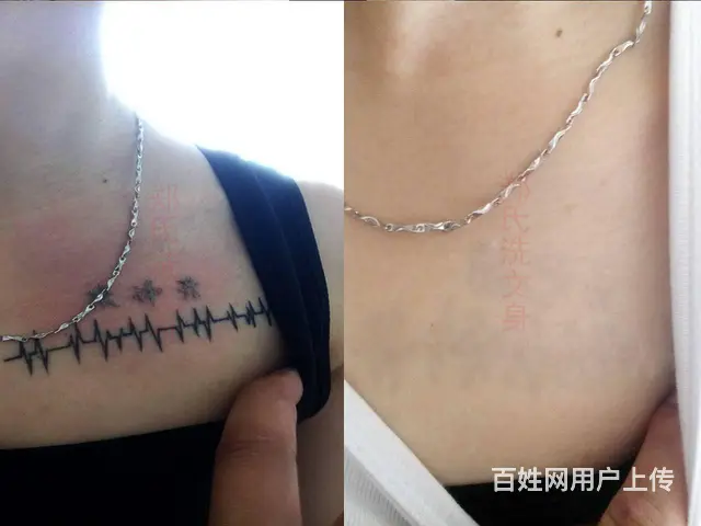 纹身要怎么做才能完全洗掉 - 图片 10