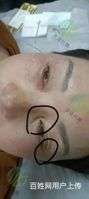 昆明针雕针灸美雕 技术培训 - 图片 5