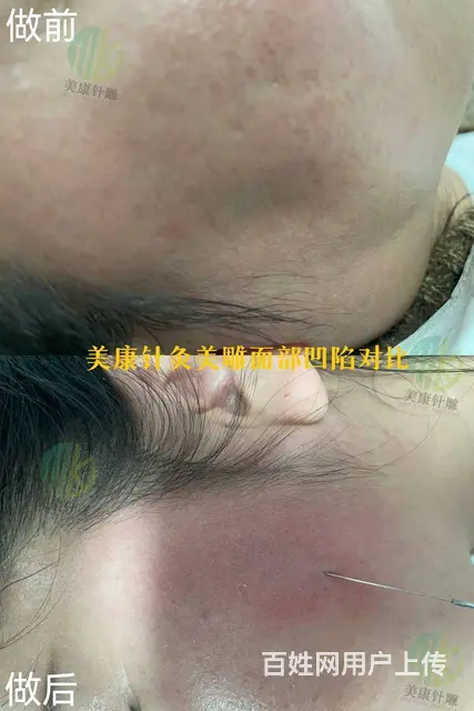 乌鲁木齐一根针灸美雕技术 效果才是王道 - 图片 1
